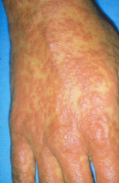 /dateien/mg69294,1294098313,Penicillin Allergy Resulting in Morbilliform Rash-124