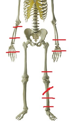 Skeleton with Location of Injuries large