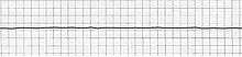220px-EKG Asystole