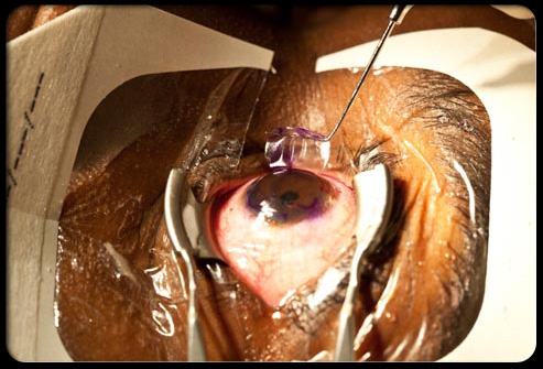 laser-eye-surgery-s5-photo-of-cornea-fla