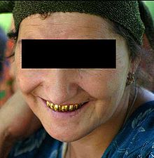 220px-Tajikistan gold teeth new