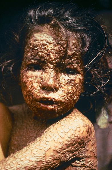 393px-Child with Smallpox Bangladesh