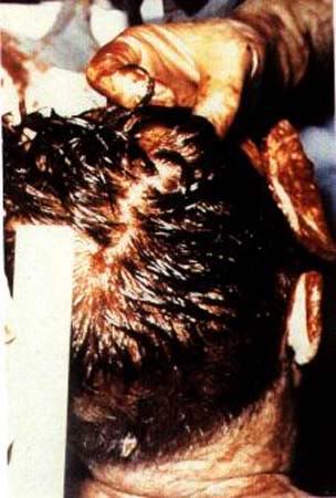 JFK Autopsy Photo 1