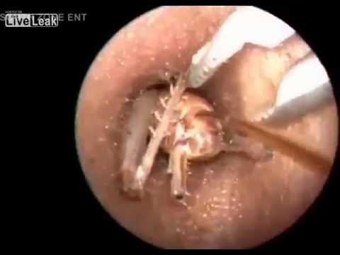 Youtube: Tickly ear - Big Bug removed from a Ear!!