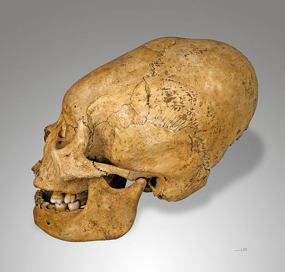 skull-deformation