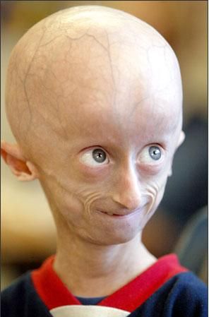 progerie