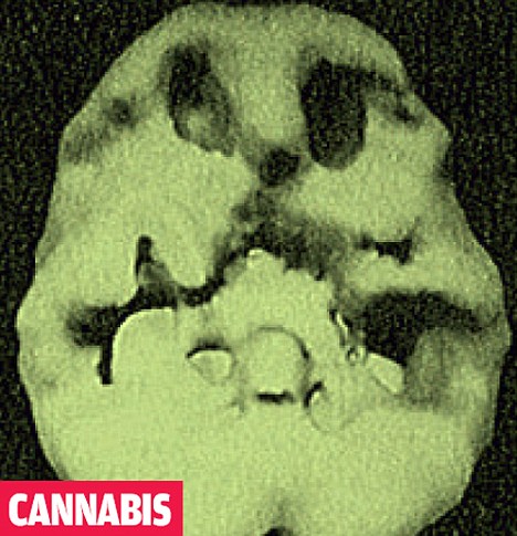 cannabis-brain