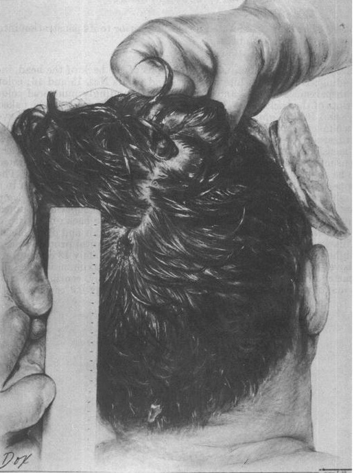 /dateien/gg4378,1275473072,JFK posterior head wound