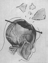 /dateien/gg4378,1275476636,200px-JFK skull trajectory