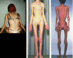 /dateien/mg20885,1137059165,anorexia.jpg.w300h239