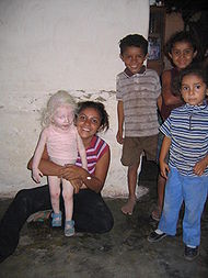 /dateien/mg47671,1229785301,190px-Albino girl honduras