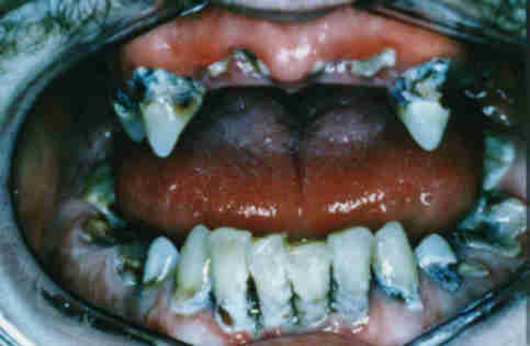 Zähne durch drogen schlechte Zahnverlust: Drogenabhängige
