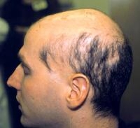 sisaipho alopecia areata