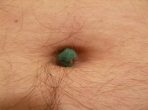 /dateien/vo62185,1271871508,300px-Navel lint ball