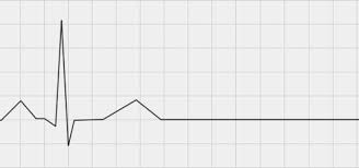 Brockis EKG