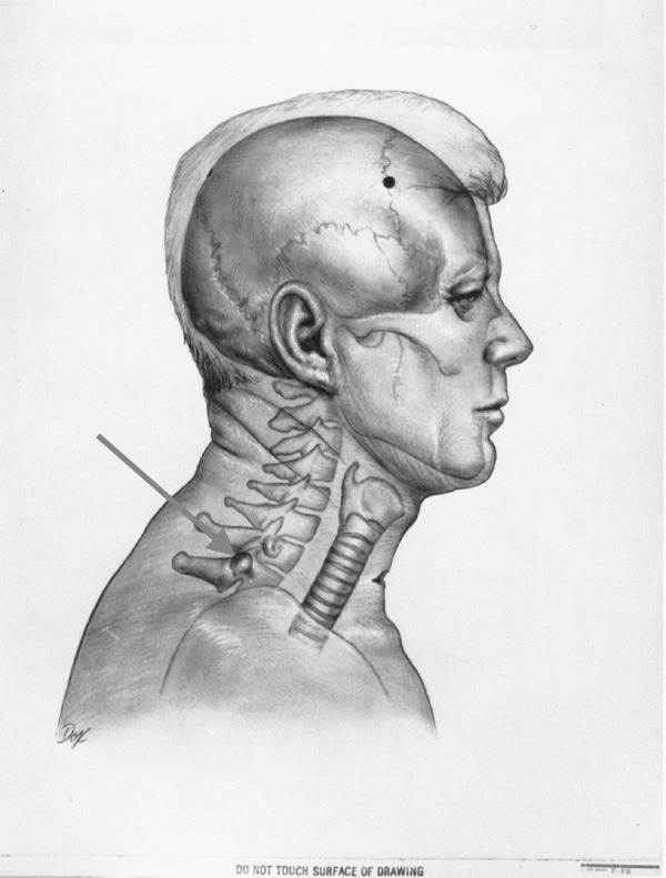 jfk profile w wound sites and cervical s