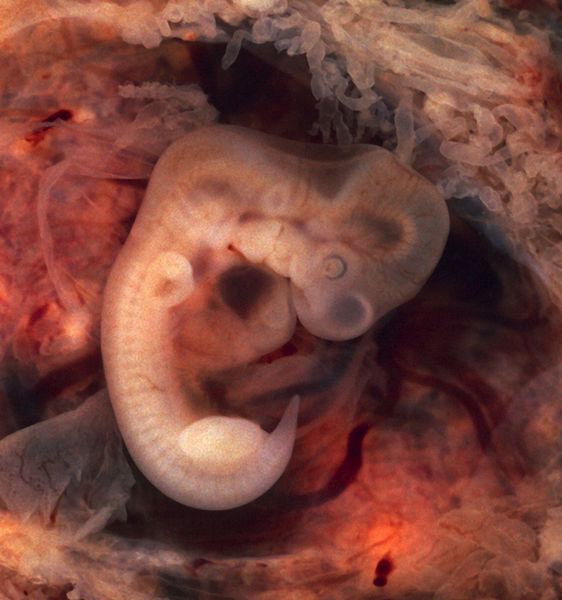 562px-Tubal Pregnancy with embryo