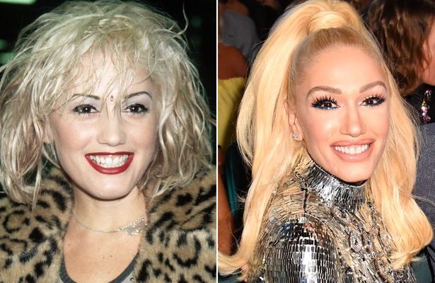 Gwen-Stefani-Botox-Plastic-Surgery-Befor