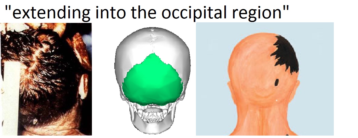 jfkoccipital