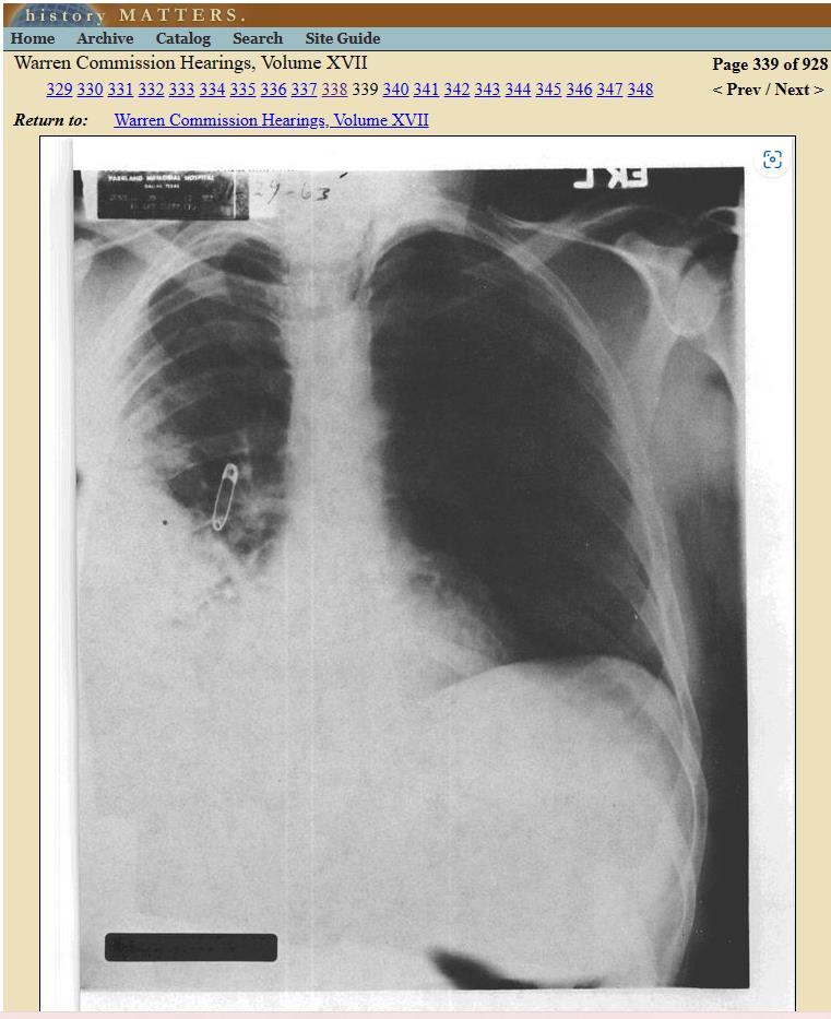 Conally X-Ray Chest