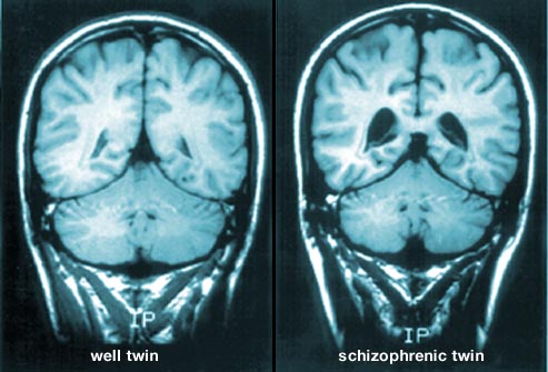 webmd rf photo of mri brain scans