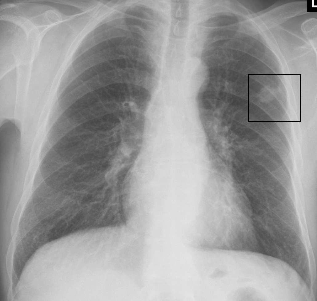 Thorax pa peripheres Bronchialcarcinom l