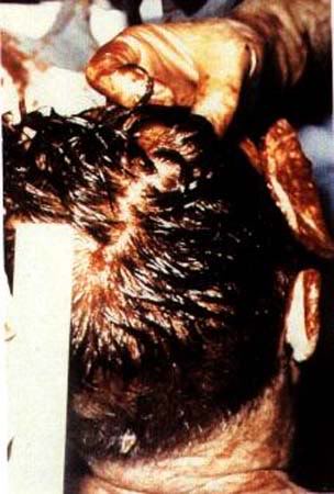 teb6ab5 JFK Autopsy Photo 1