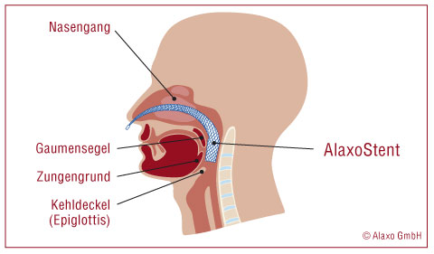 AlaxoStent2