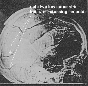 t256d07f7e t751ac7 x ray fractures