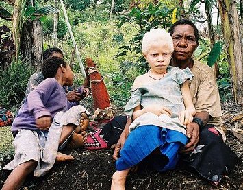 Albinistic girl papua new guinea