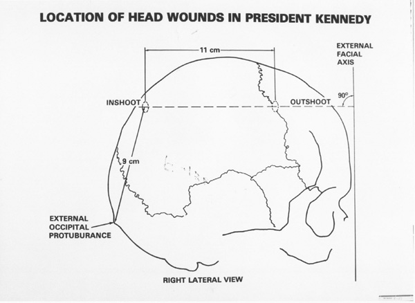 head wounds lateral view JFK F 137