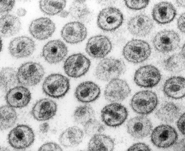 HIV-1 Transmission electron micrograph A