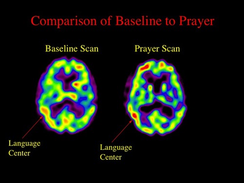 03 spect comparison of baseline to praye