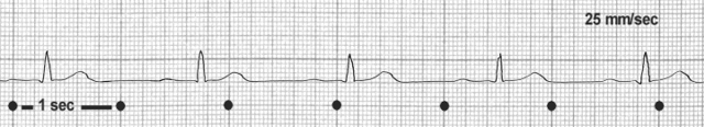 e sinusbradycardie