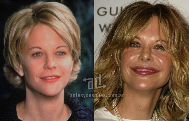 meg ryan antes y despues cirugia