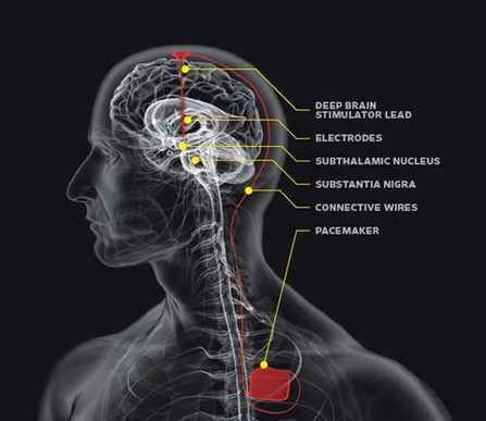 brain-interface