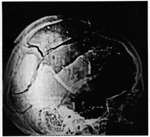 XrayLateral