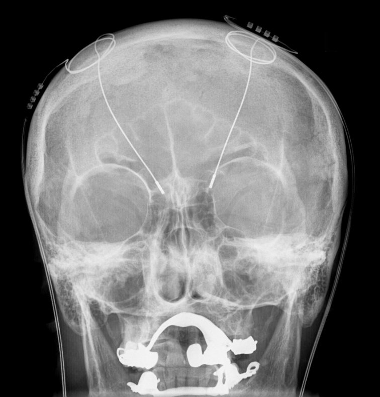 Tiefe Hirnstimulation Sonden RoeSchaedel