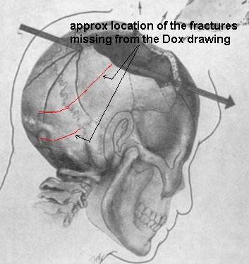 dox missing fractures