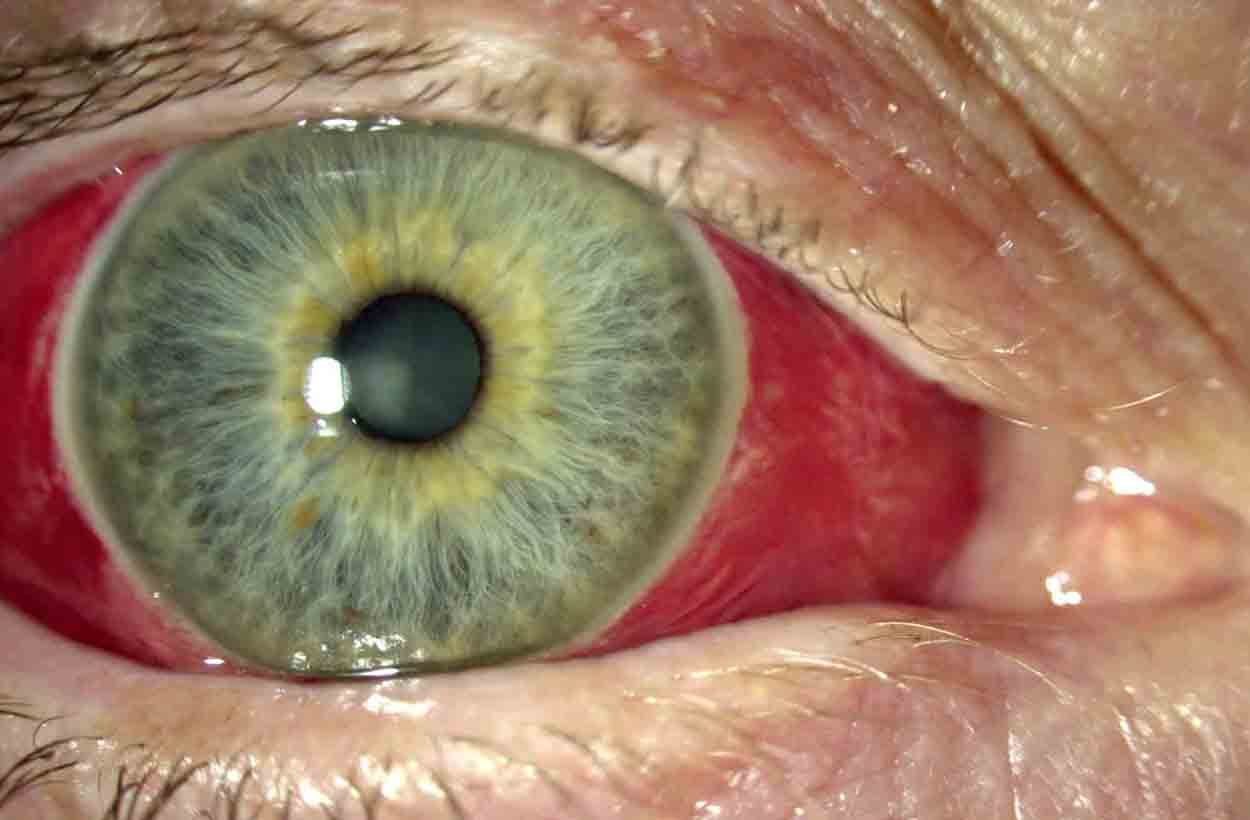 subconjunctival-haemorrhage