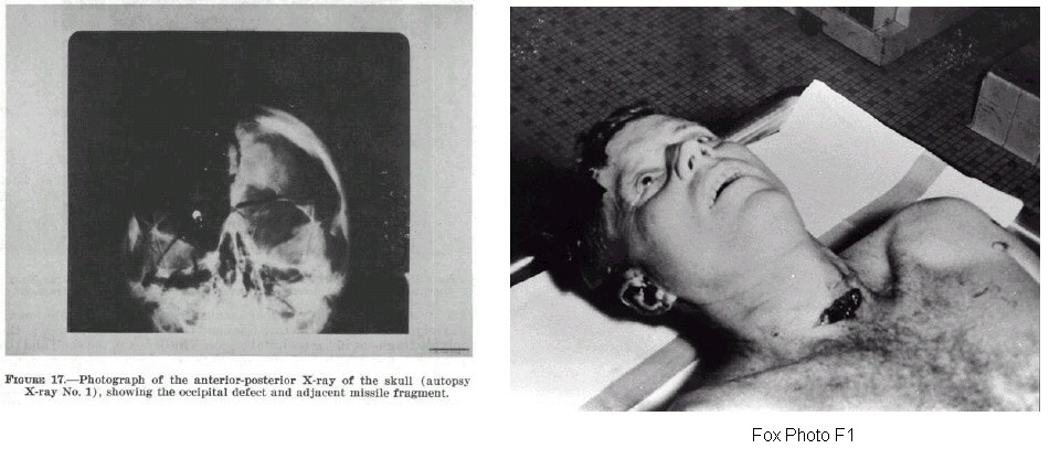 JFK-Autopsy-Pictures