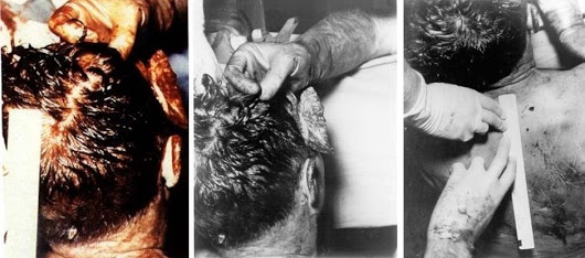 JFK-Autopsy-Photos-BOH-Composite