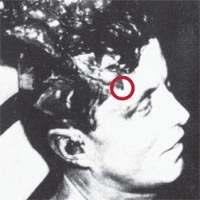 jfk headAutopsy3v