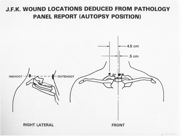 jfk-neck-wounds autopsy-position-JFK-F-3