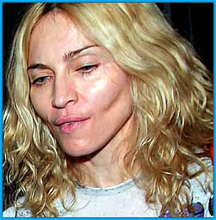 Madonna-Plastic-Surgery-before