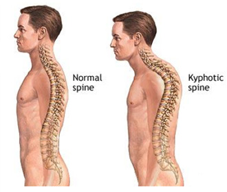 kyphosis-treatment