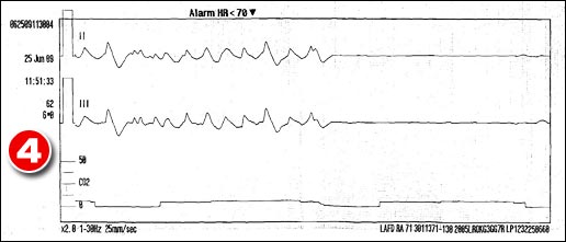 HY6tc6 ekg-mj