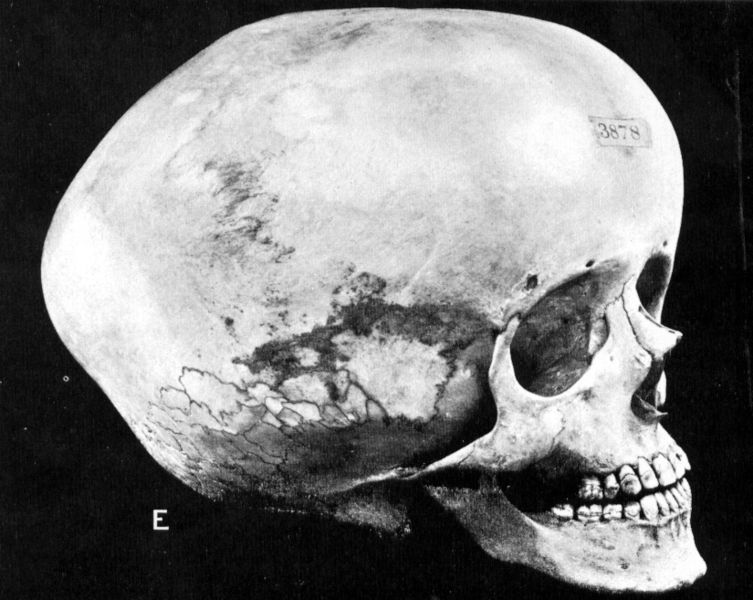 753px-Hydrocephalic skull