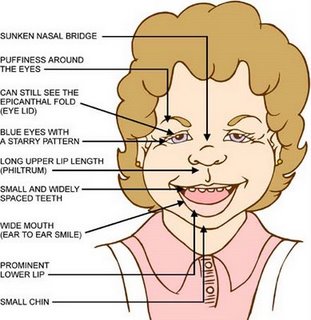 YbMpmH Williams-syndrome