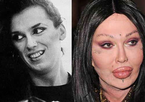 nXOAZg Surgery-Pete-Burns